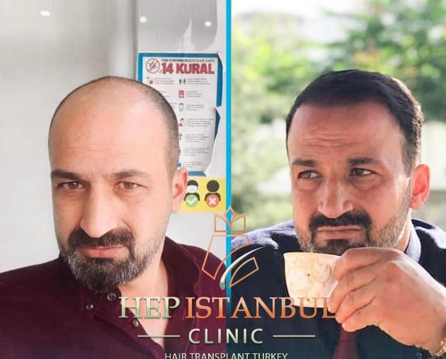 Hair Transplant Without Surgery: Is It the Perfect Option for You?