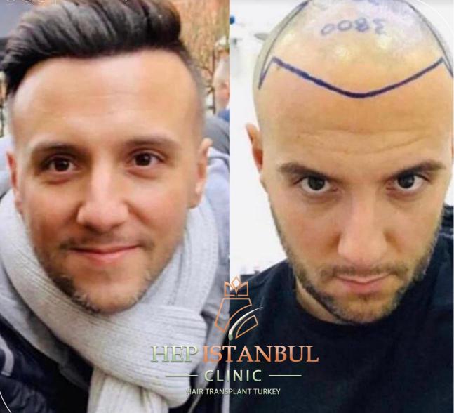 The Role of Nutrition in the Success of Hair Transplant and Accelerating Hair Growth