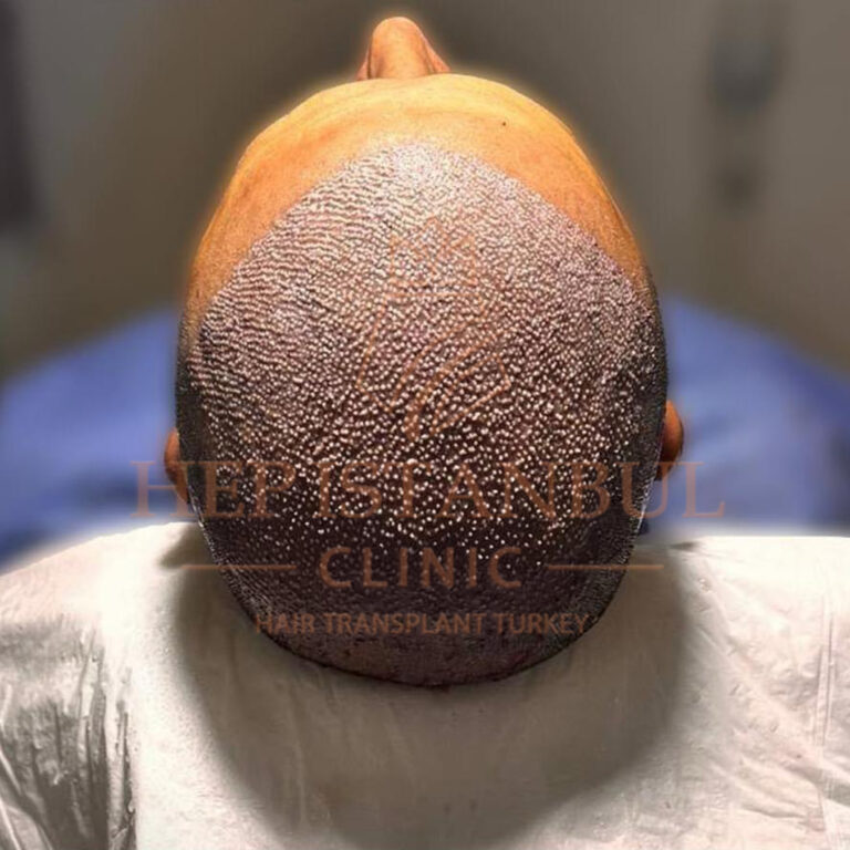 زراعة الشعر بدون جراحة: هل هي الخيار المثالي لك؟