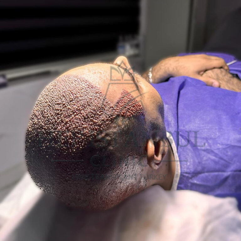 Hair Transplant Benefits: A Step Towards Restoring Self-Confidence