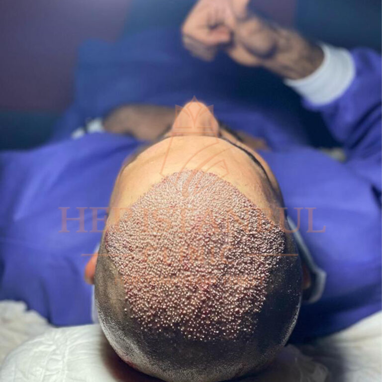 زراعة الشعر للرجال: كيف تختار التقنية المثالية لشعرك؟