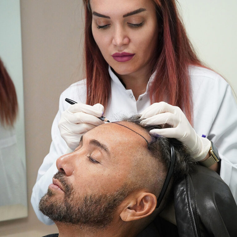 Hair Transplant for Men: How to Choose the Perfect Technique for Your Hair?