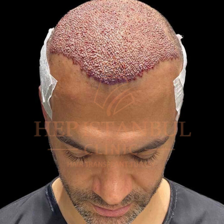FUE Hair Transplant: The Best Choice for Natural Hair Restoration