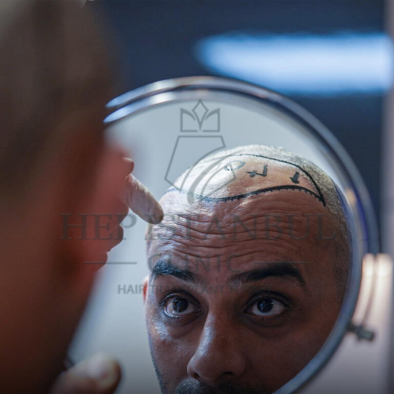 زراعة الشعر بتقنية FUE: الخيار الأمثل لاستعادة الشعر الطبيعي