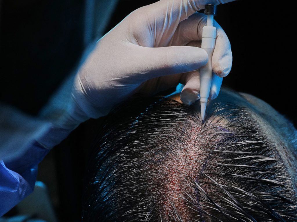 Hair Transplant Without Shaving