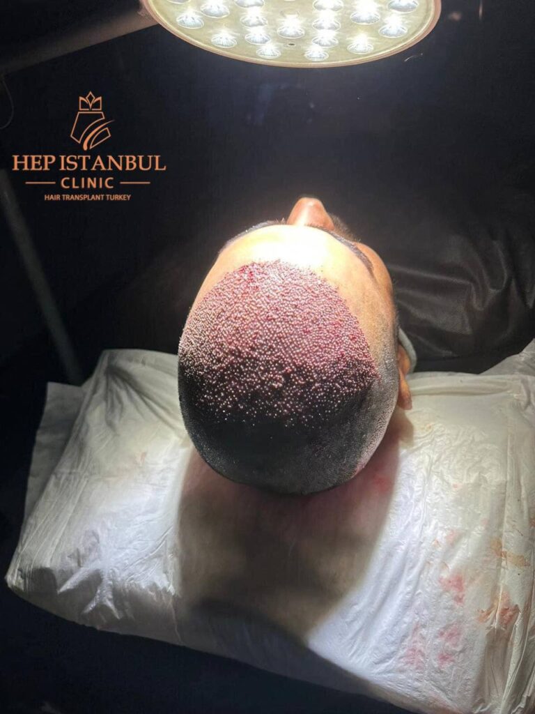 زراعة الشعر: الحل الأمثل لاستعادة الثقة والمظهر الجمالي