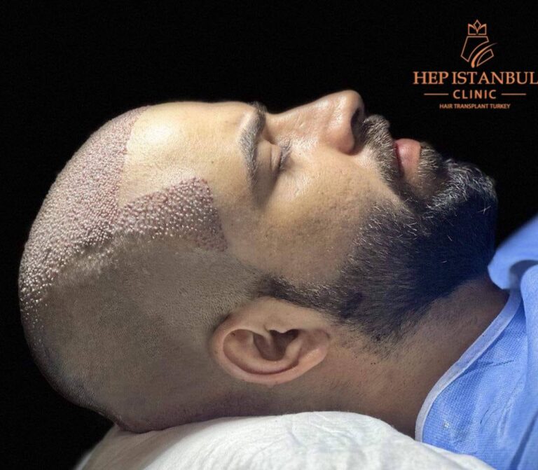 أفضل 5 نصائح لتحسين نتائج زراعة الشعر بعد العملية